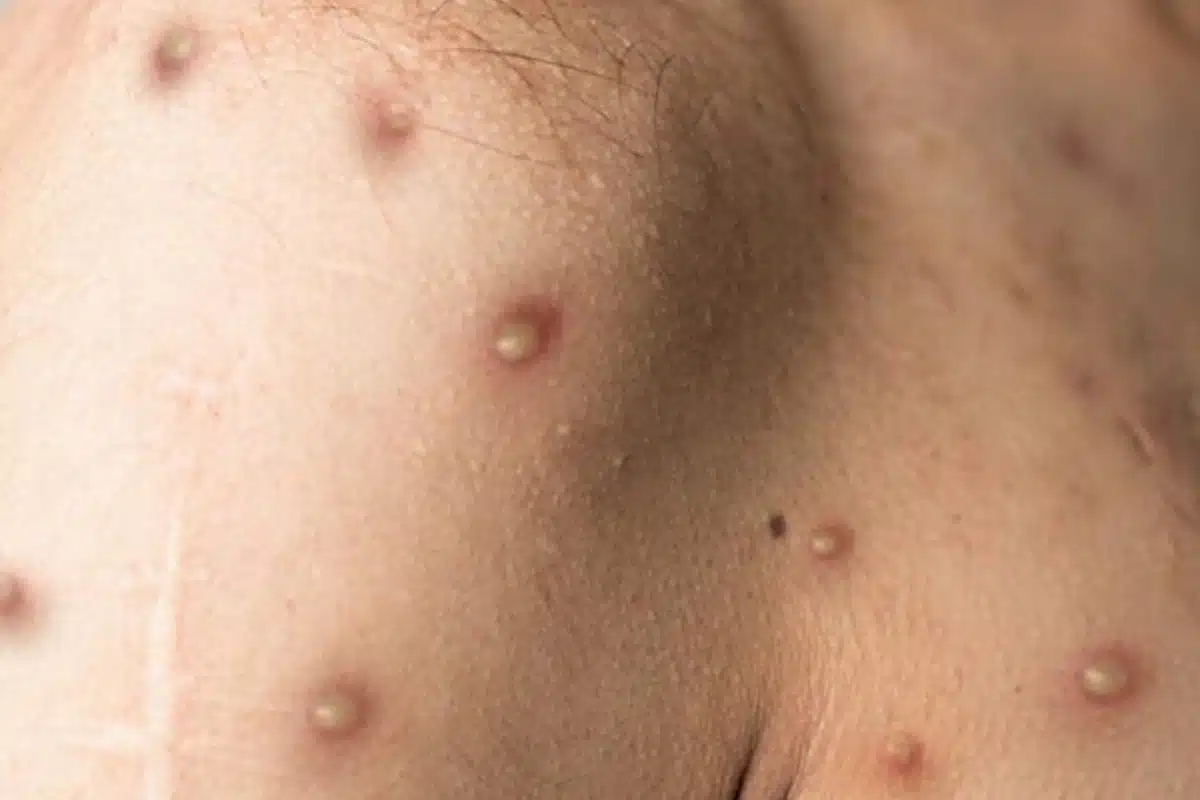 varíola Monkeypox